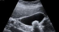A Guide to Gallstones