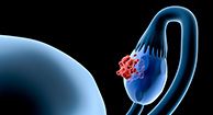 What Causes Ovarian Cancer?