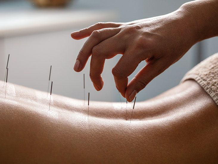 Can Acupuncture Relieve Sacroiliac (SI) Joint Pain?