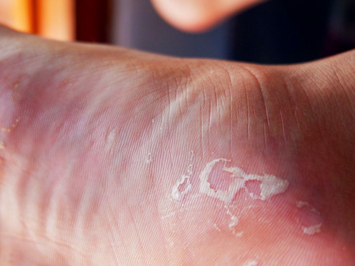 What Is Acral Peeling Skin Syndrome?