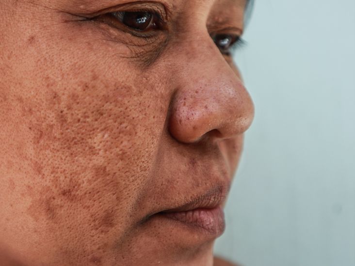 What Causes a Melasma Mustache and How to Treat It