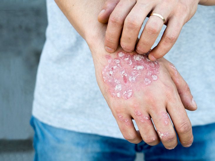 Causes and Treatments for Hand Psoriasis