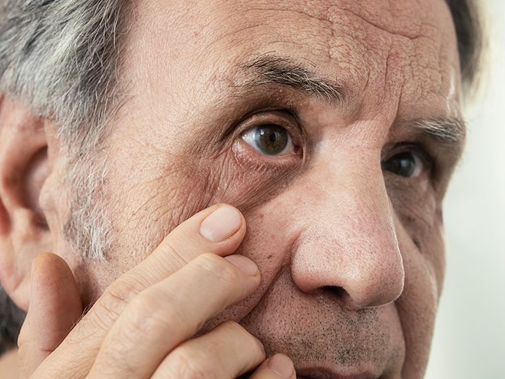 What Are the Possible Complications of Shingles?