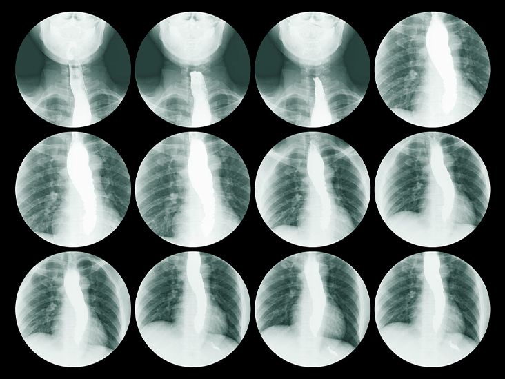 What to Know About Small Cell Esophageal Cancer