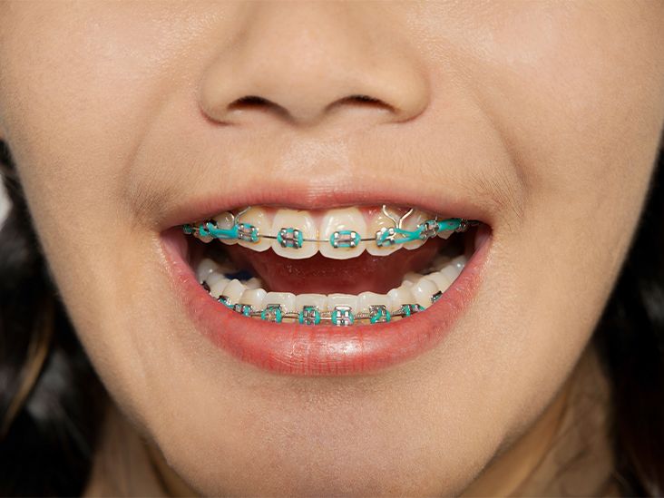 Is Dental Discoloration Caused by Braces Permanent?